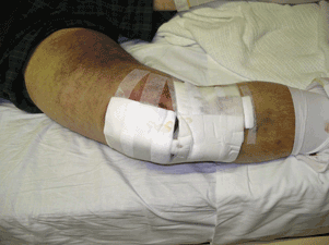Knee Replacement